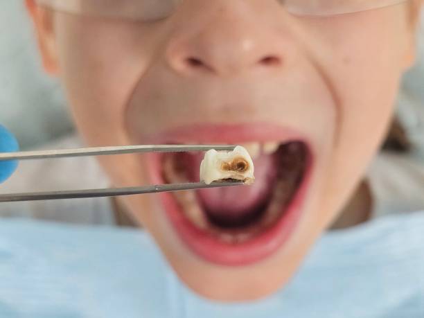 Best Emergency Tooth Extraction in Venice, IL