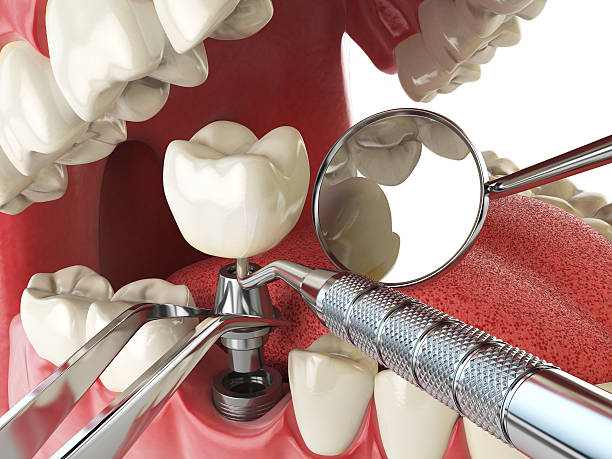Best Emergency Dental Care for Broken or Chipped Teeth in Venice, IL